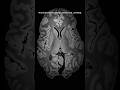 In neurosurgery, precision is everything. This is the future of understanding the brain.