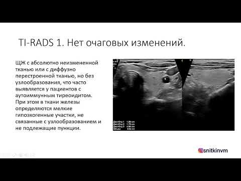 ИСПОЛЬЗОВАНИЕ TI-RADS (ТИРАДС) В ПРАКТИКЕ ВРАЧА УЛЬТРАЗВУКОВОЙ ДИАГНОСТИКИ. Часть 1.
