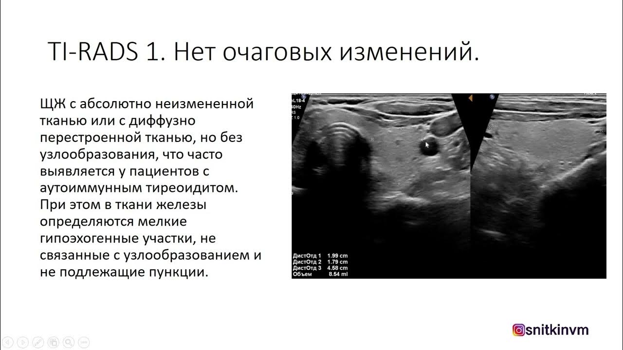 Ti rads что это значит. Классификация Tirads щитовидная железа по УЗИ. Классификация тирадс щитовидной железы УЗИ. Тирадс УЗИ. Тирадс щитовидной железы по УЗИ.