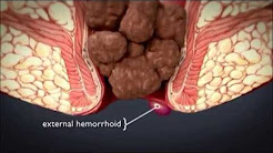 HEMORRHOiDS | What are hemorrhoids ? What is the treatment for hemorrhoids ?