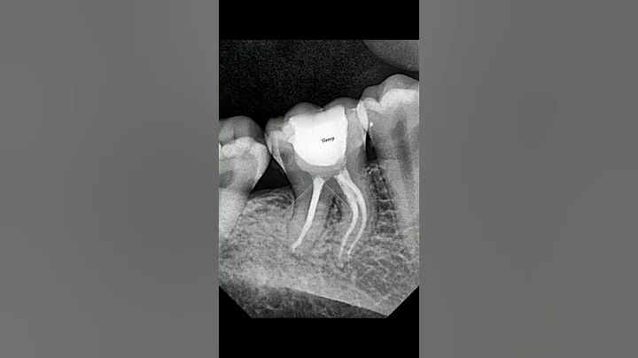 Management of  curved root canal #rct #endodontics #shortvideo #rootcanal #curvodontics#curvedroot