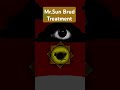 mr sun brud treatment