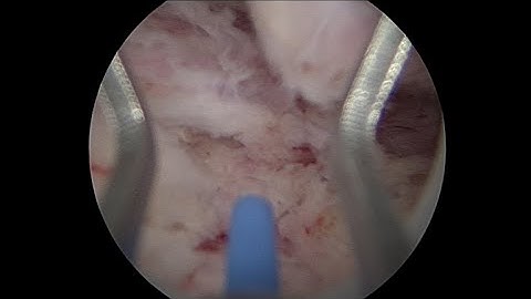 HOLEP 50g en bloc (early apical release)