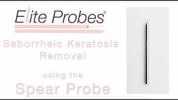 Spear Probe | Seborrhoeic Keratosis Removal | Elite Probes®