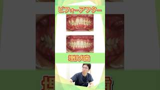 【埋伏犬歯とは?】矯正治療でどう対処するの?