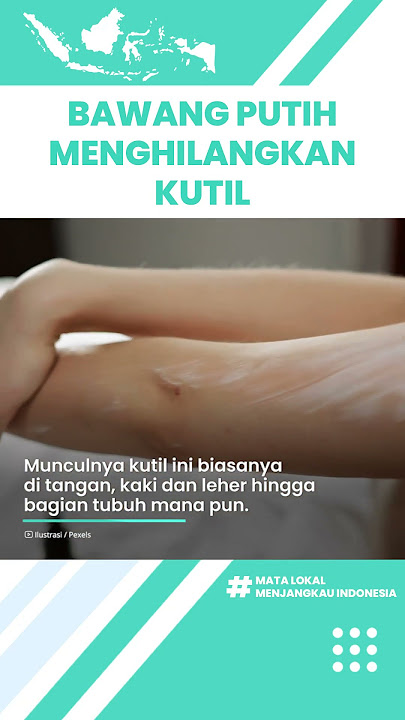 Khasiat Bawang Putih Dapat Menghilangkan Kutil, Inilah Bahan Alami yang Bisa Atasi Masalah Kulit