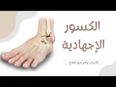 فيديو: كيفية علاج كسر إجهاد القدم: 12 خطوة (بالصور)