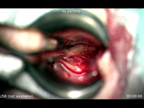 Удаление аденомы гипофиза трансназальным доступом часть 1