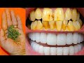 सिर्फ 1मिनिट में पीले दाँतों को मोती जैसा चमका देगा ये अद्भुत घरेलु नुस्खा।Teeth Whitening Remedy