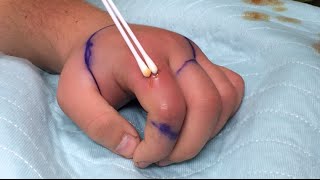 finger abscess and cellulitis