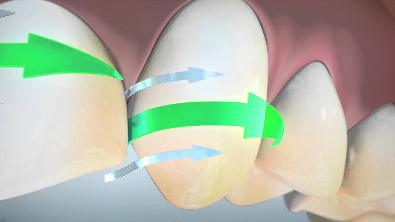 Shawnee Dental Shares Animation About Teeth Whitening in Shawnee, OK