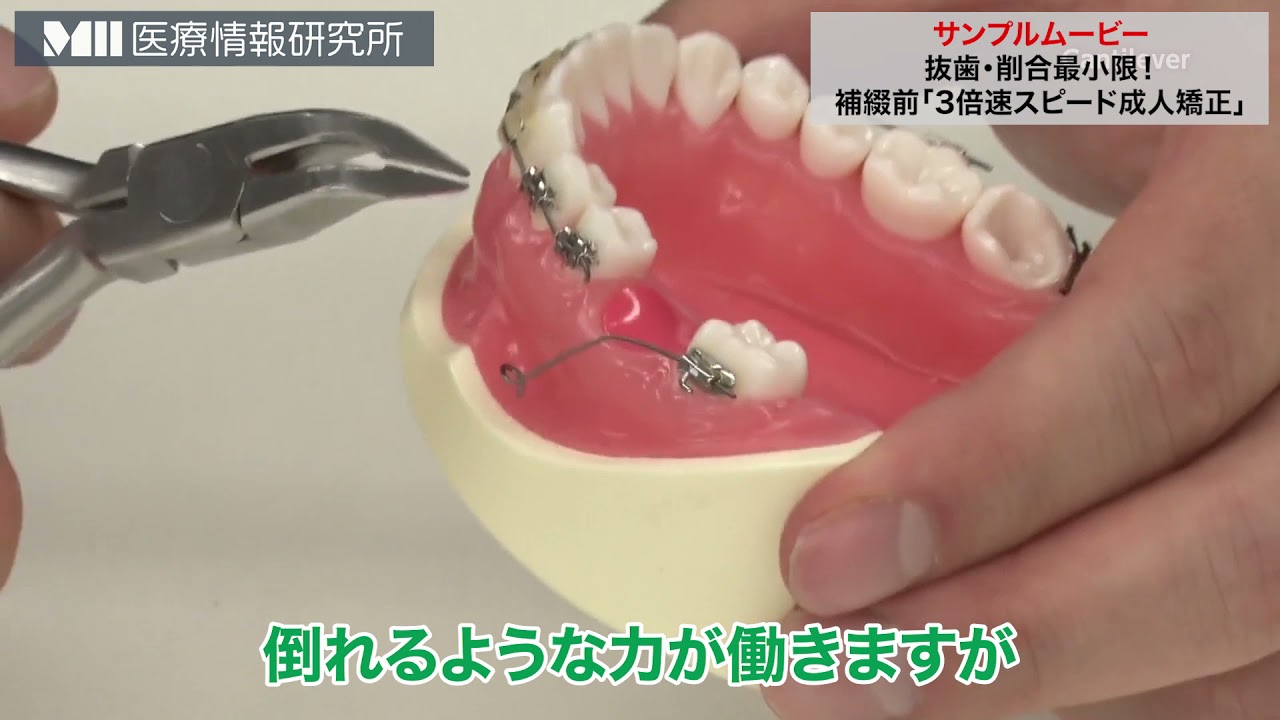 【裁断済み】矯正が先か？インプラントが先か？　欠損補綴の治療計画を極める 裁断済み】矯正が先か？インプラントが先か？ 欠損補綴の治療計画を