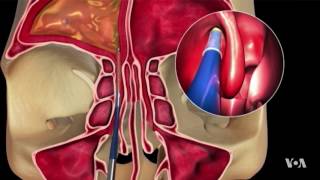 Non-Invasive Procedure Is Proving Successful in Sinusitis Treatment