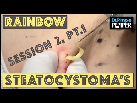 Rainbow Steatocystomas - Session 2, Pt. 1
