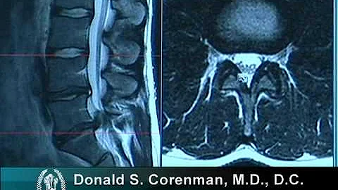 How to Read a MRI of a Lumbar Herniated Disc | Lower Back Pain | Colorado Spine Surgeon - DayDayNews