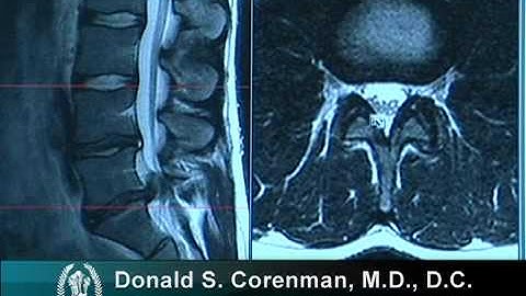 How to Read a MRI of a Lumbar Herniated Disc | Lower Back Pain | Colorado Spine Surgeon