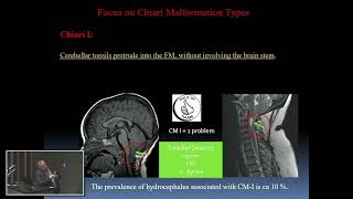 Surgical Managment of Chiari Malformation from Ekkehard Kasper, MD