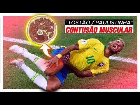 Distensão Muscular - Dr. João Hollanda