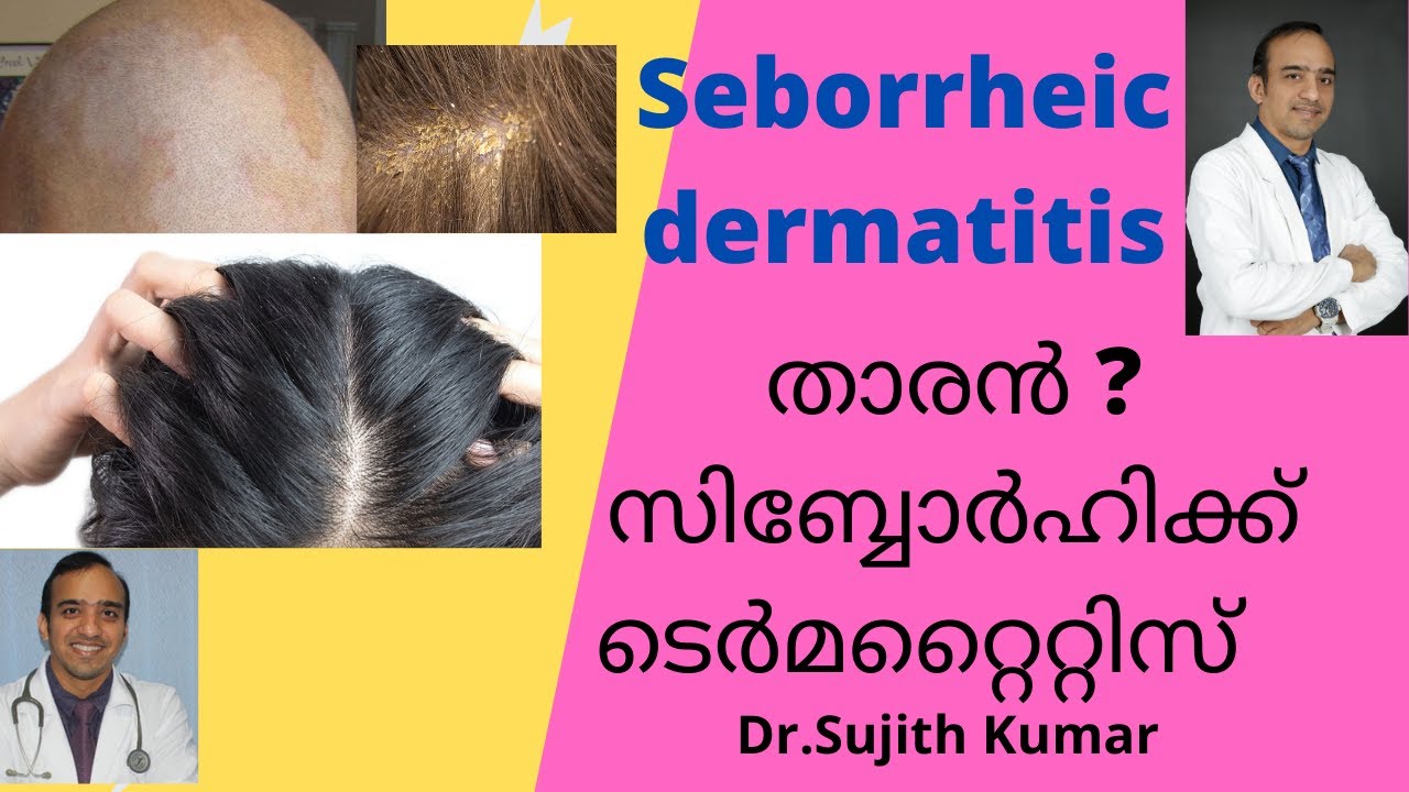 seborrheic dermatitis / താരൻ Malayalam  സ്കിൻ ഹെൽത്ത് talk./Dr.Sujith Kumar