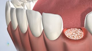 Post-Operative Instructions: Following Bone Grafting Surgery | Oral Surgery