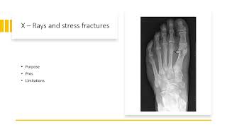 X-Rays vs. MRI for Stress Fractures
