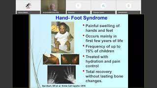 Bone Health & Avascular Necrosis in SCD by Dr. James Eckman