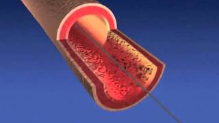 Angioplasty Stent