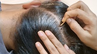 99% Fall Asleep Fast 💤 Satisfying Scalp Check ASMR