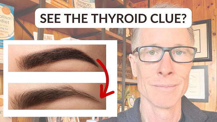 The Hair Loss Warning Sign Doctors Often Miss (Thyroid)