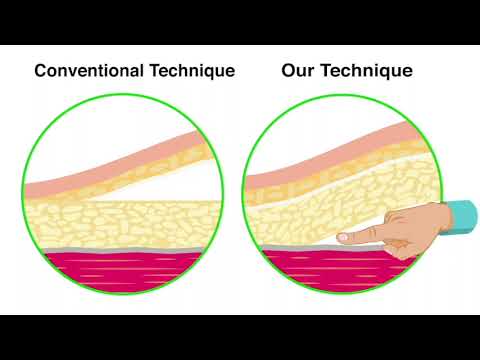 Fascia Lata First Approach to Robotic VEIL(Video Endoscopic Inguinal Lymph node Dissection) Ca Penis
