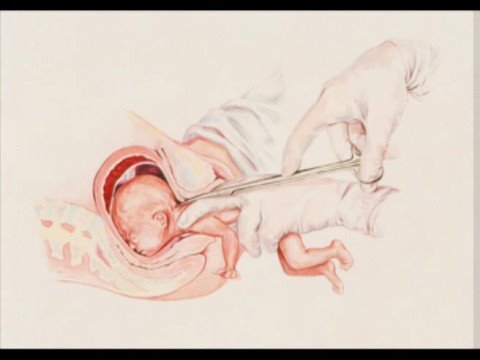 Реферат: Partial Birth Abortion Essay Research Paper PartialBirth
