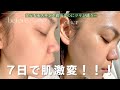 ハーブピーリングしたら念願の韓国風ツヤ肌に一歩近づいた…気がする!!これはハマる😳