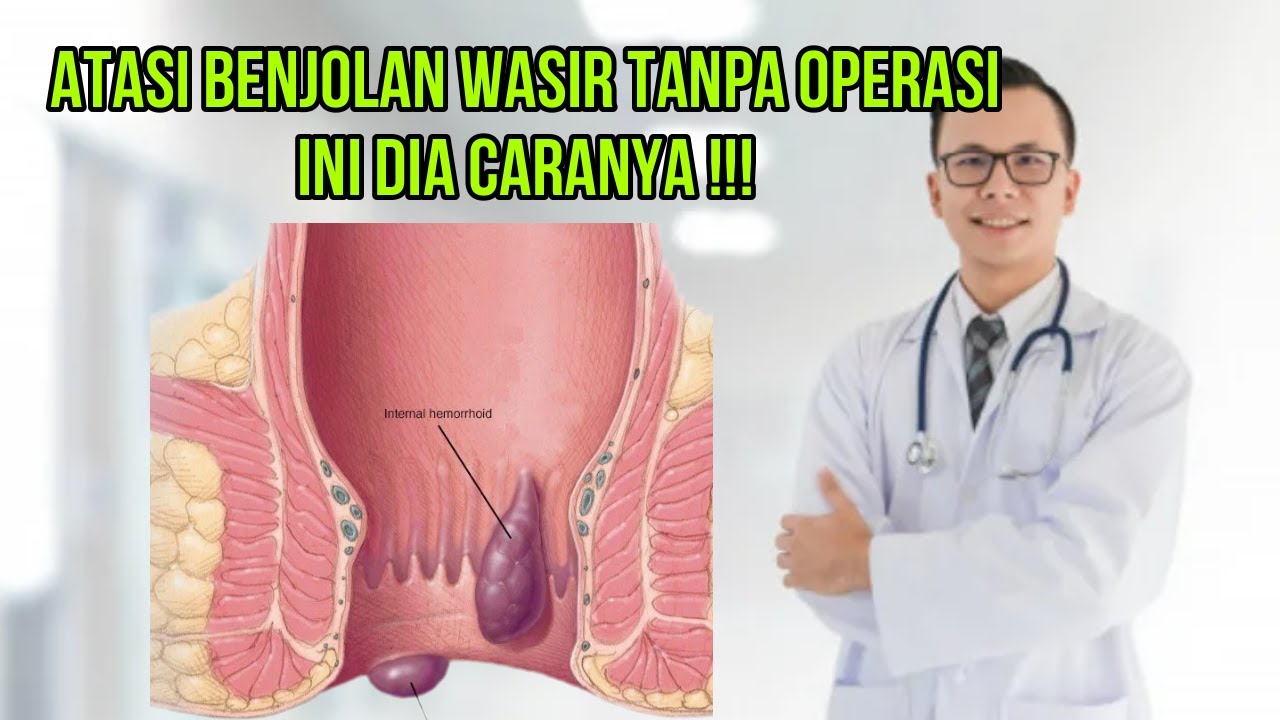 CARA MENYEMBUHKAN WASIR TANPA OPERASI