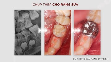Tập 15: Chụp thép răng sữa dự phòng sâu răng cho trẻ em x bs Hoàng Ngọc Quyết