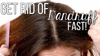 How to get rid of Dandruff FAST!! Only 2 Ingredients! Highly effective!