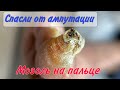 Страшная мозоль на пальце/ как убрать мозоль /ампутация пальца