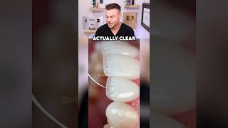 How To Get Veneers That Dont Ruin Your Real Teeth