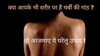 शरीर में चर्बी की गांठ का घरेलू उपाय I Home Remedies To Cure Lipoma I Charbi Ki Ganth Kaise Hataye