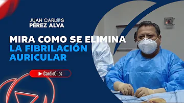 ¿La fibrilación auricular desaparece por completo?