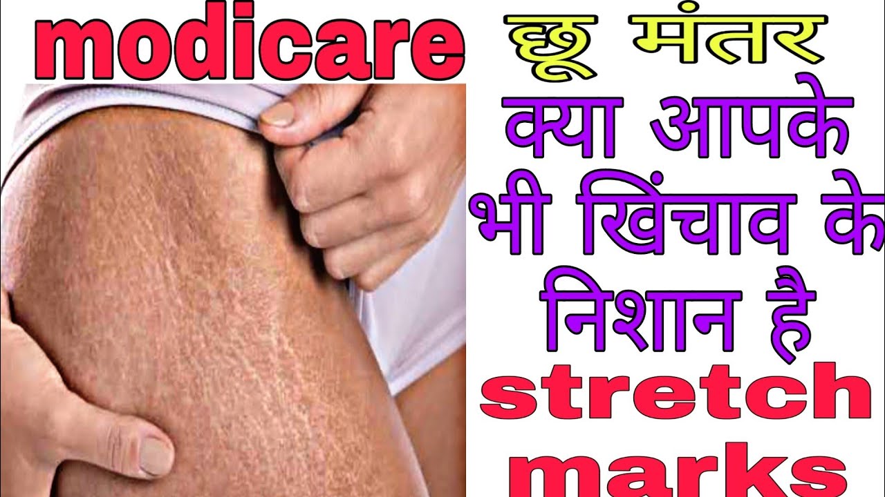 modicare product for stretch marks
