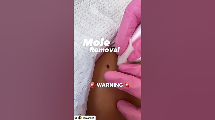 Mole Removal