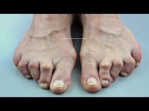 15-signs-&-symptoms-of-foot-problems-&-what-they-reveal-about-your-health