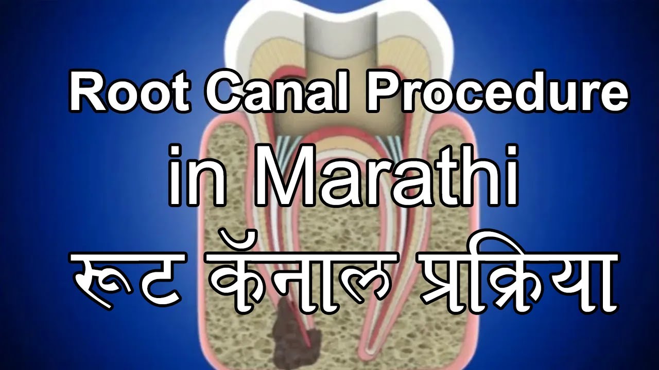 रूट कॅनाल प्रक्रिया मराठी Root Canal Procedure in Marathi YouTube