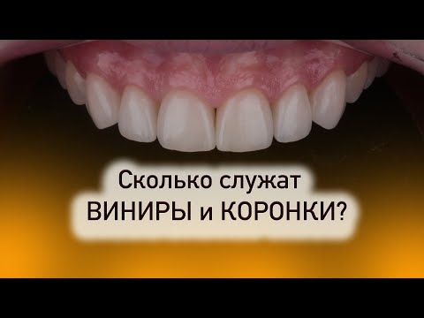 Сколько служат виниры и коронки на зубах?