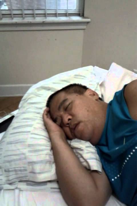 Obstructive sleep apnea