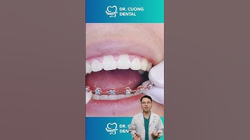 Răng đều rồi, tháo mắc cài thôi |Dr Cường Official