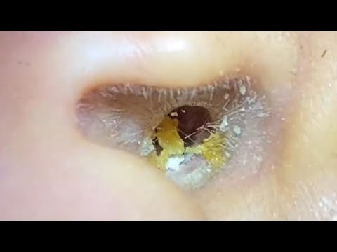 ASMR Ear Cleaning – When the Ear Turns Into a Wax Factory!