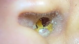 ASMR Ear Cleaning – When the Ear Turns Into a Wax Factory!