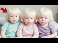 You Remember the Albino Triplets from 1985 with Fire-Colored Eyes? See How They Look Today