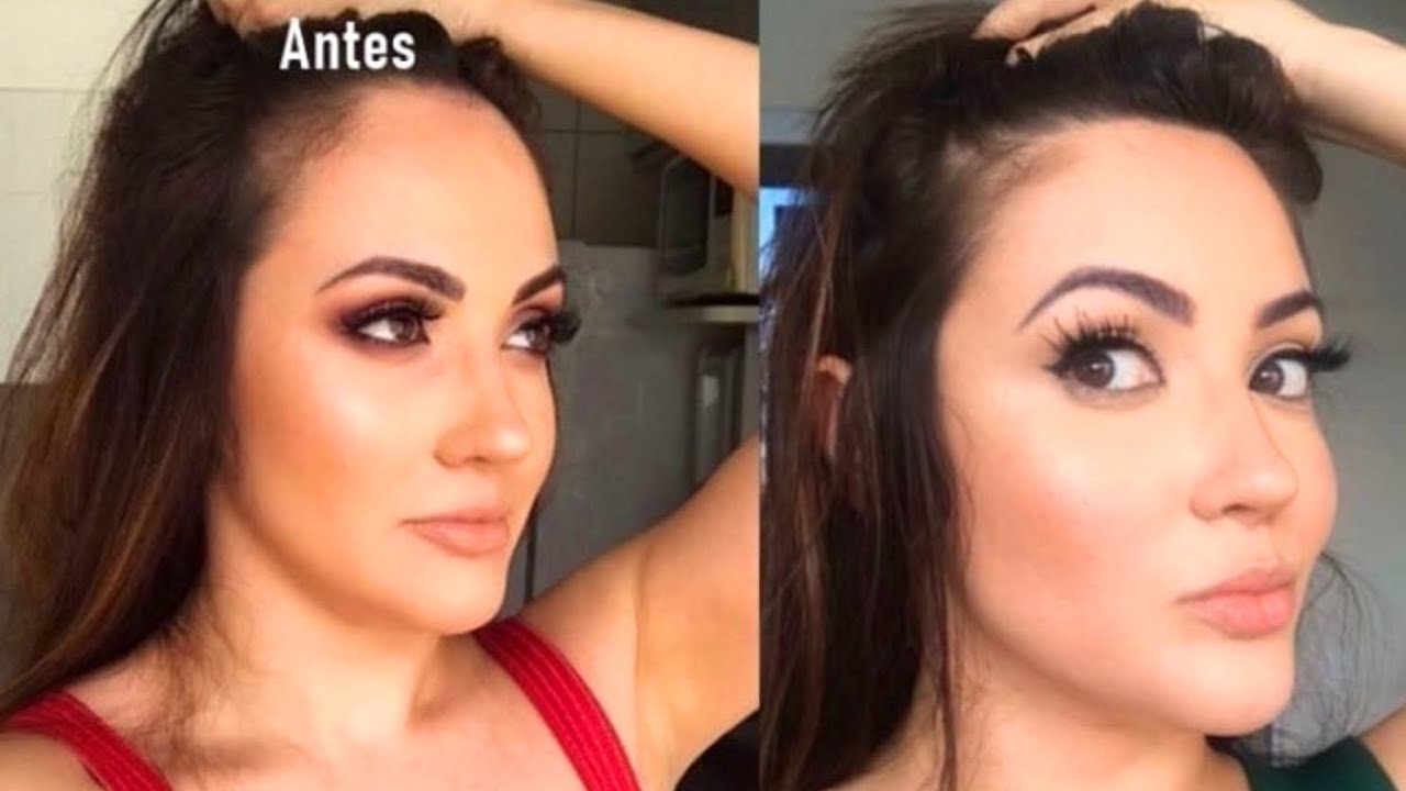 Frontoplastia (cirurgia da testa): Quanto custou tudo? Exames? - YouTube